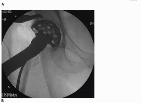 صورة طبية: النهج الأمامي لاستبدال مفصل الورك الكلي: ثورة في جراحة الورك مع الأستاذ الدكتور محمد هطيف في صنعاء