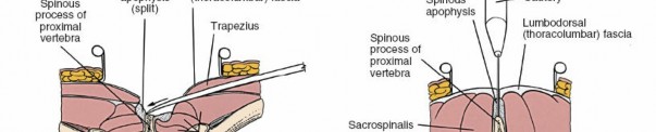 Illustration 349 for Approach to the Lumbar Spine: Mastering Techniques & Anatomy