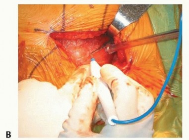 Illustration 25 for Hemiarthroplasty of the Hip: Indications & Types Explained