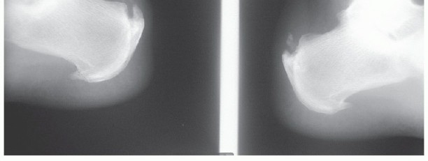 Achilles Tendinosis Relief: Flexor Hallucis Longus Tendon Augmentation