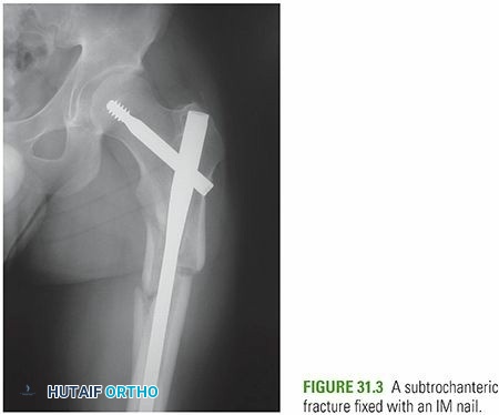 Comprehensive Guide to Subtrochanteric Femoral Fractures: Epidemiology, Anatomy, & Management