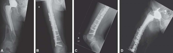 Illustration 27 for Mastering Fractures After Total Hip Arthroplasty