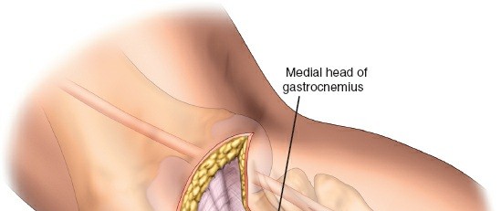 Illustration 39 for Surgical Access: Mastering the Tibia's Surface & Fibula Approaches