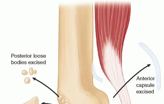 Elbow Contracture: Continuous Passive Motion for Lasting Relief