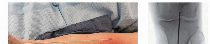 Illustration 19 for Advanced Nailing of the Mature Tibia: Overcoming Complexities