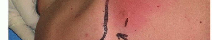 Illustration 22 for Is Your Dorsal Scapular Nerve Causing Snapping Scapula Pain?