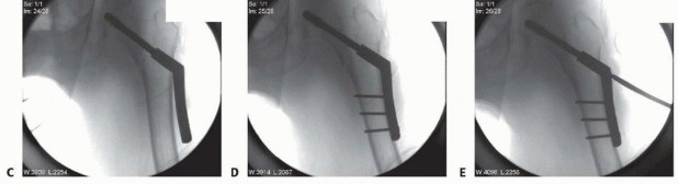 Illustration 16 for ORIF for Peritrochanteric Hip Fractures: Achieve Stable Mobility