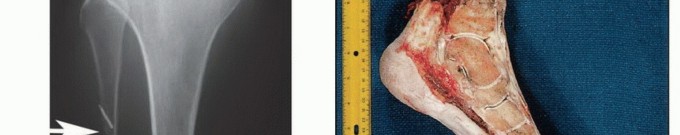 Illustration 12 for Below-Knee Amputation: Maximize Your Below-Knee Recovery & Function