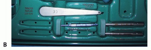 Illustration 11 for Hammer Toe Correction: Understanding the Extensor Digitorum Longus