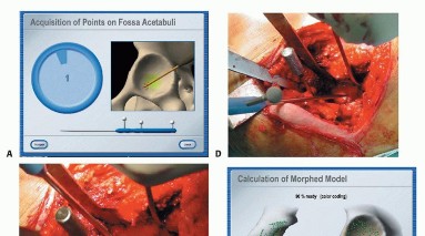 Illustration 22 for Hip Resurfacing: The Bone-Sparing Solution around the Femoral Head