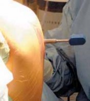 Illustration 26 for Knee Arthroplasty Unicondylar: Discover if Partial Knee Replacement is Right