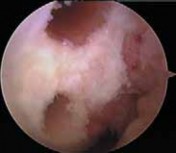 Illustration 18 for Cruciate Ligament Repair: Definitive Guide to Treatment & Recovery