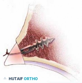 Illustration 24 for FAI: Impingement and Surgical Dislocation Explained