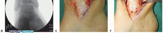 Illustration 4 for Unlock Healing: Medial Malleolar Osteotomy for Talus OLT Allografts