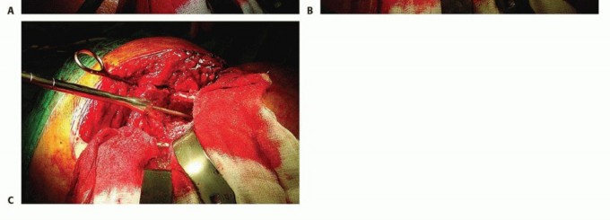 Illustration 14 for Exeter Hip Unit: Mastering Impaction Allografting for Femoral Bone Loss