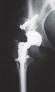 Illustration 118 for Successful Total Hip Replacement in Developmental Dysplasia