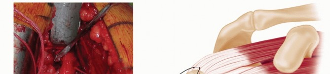 Illustration 13 for Optimizing Fixation of Proximal Humerus Fractures: A Guide