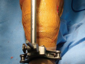 Illustration 12 for Minimally Invasive Subvastus: The Best Path to Quicker TKA Recovery