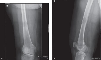 Unraveling Metastatic Bone Disease: Key Orthopedic Case Insights