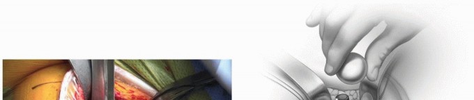 صورة طبية: النهج الأمامي لاستبدال مفصل الورك الكلي: ثورة في جراحة الورك مع الأستاذ الدكتور محمد هطيف في صنعاء