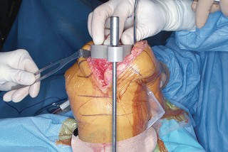 Illustration 31 for Mastering Valgus Total Knee Replacement: Techniques & Pitfalls