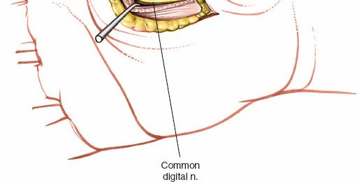 Illustration 237 for Essential Surgical Approaches: Uncover Every Aspect of the Wrist