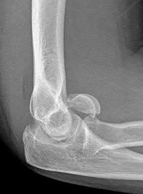 Illustration 83 for OrthoCash: Trauma MCQs & Cases for a yearold woman