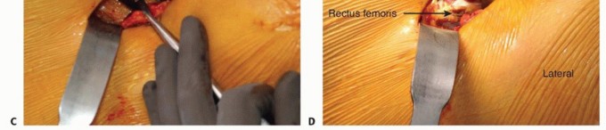 Illustration 15 for Anterior FAI Relief: Mini-Open Anterior Approach Explained