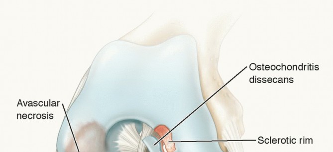 Dissecans of the Knee: What's the Difference – OCD vs. AVN?