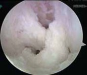 Illustration 14 for Cruciate Ligament Repair: Definitive Guide to Treatment & Recovery