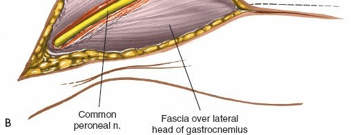 Illustration 93 for Surgical Access: Mastering the Tibia's Surface & Fibula Approaches