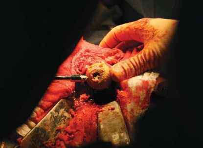 Illustration 64 for Metal on Metal Resurfacing: Enhanced Posterior Soft Tissue Repair