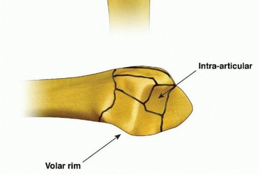 Illustration 5 for Fragment-Specific Fixation: Restore Carpal Facet Horizon