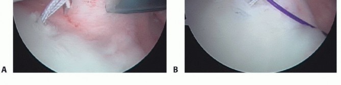 Illustration 7 for Mastering the Treatment of Recurrent Posterior Shoulder Instability