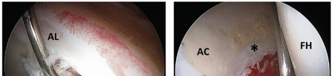 Illustration 16 for Beyond Knee Surg: Hip Arthroscopy for Sports Injuries