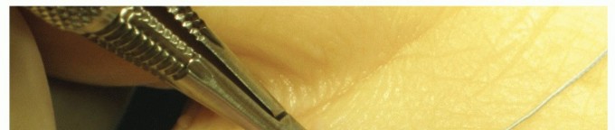 Illustration 19 for Plantar Plate Repair: End Lesser Toe Pain & Instability