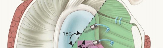 Illustration 7 for Regain Stability: Arthroscopy for Anterior Instability & the Inferior Glenohumeral Ligament