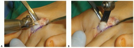 Fix Long Metatarsals: Metatarsal Shortening Osteotomy Relief