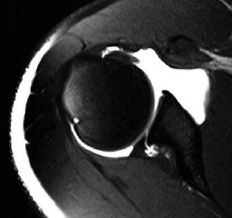 Illustration 4 for Diagnose Posterior Labrum Tear: Your Interactive Ortho Case