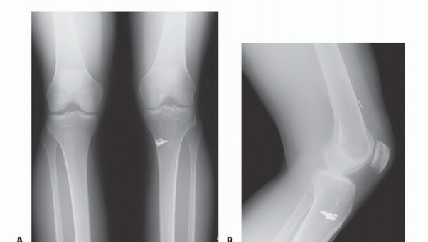 Failed Primary ACL Reconstruction? Solutions & Next Steps