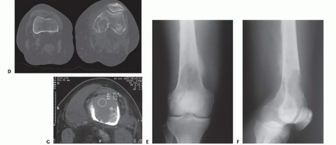 Illustration 3 for Mastering Femoral Metastases: Optimal Function for Femoris & Vastus
