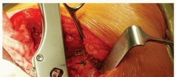 Illustration 16 for Why Polished Tapered Cemented Stems Excel in Hip Replacement