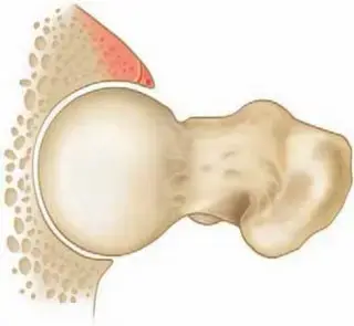 Resolving Femoral Head Neck Impingement: Arthroscopic FAI Solutions