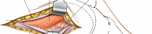 Illustration 226 for Mastering Knee Approaches: Spotlight on Superficial Medial Ligament