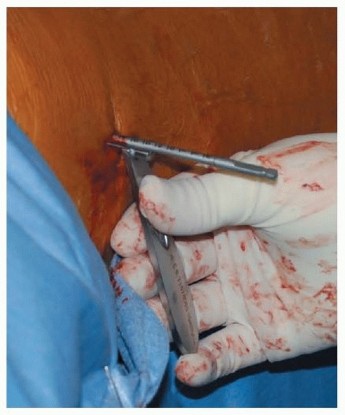 Illustration 32 for Achieve Optimal Femoral Head Fixation with Cephalomedullary Nailing