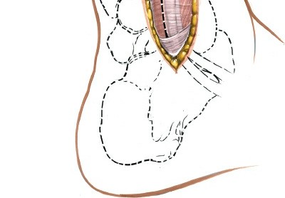 Illustration 69 for Optimized Approaches to the Dorsum of the Foot & Ankle
