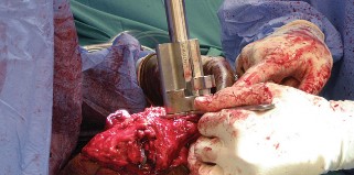 Illustration 32 for Hinged Total Knee: The Salvage Solution for Challenging Cases