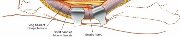 Illustration 45 for Optimal Femoral Approaches: Mastering the Lateral Intermuscular Septum