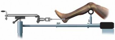Illustration 19 for Optimal Nailing of the Tibia: Techniques for Challenging Fractures