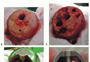Illustration 14 for Hip Resurfacing: The Bone-Sparing Solution around the Femoral Head